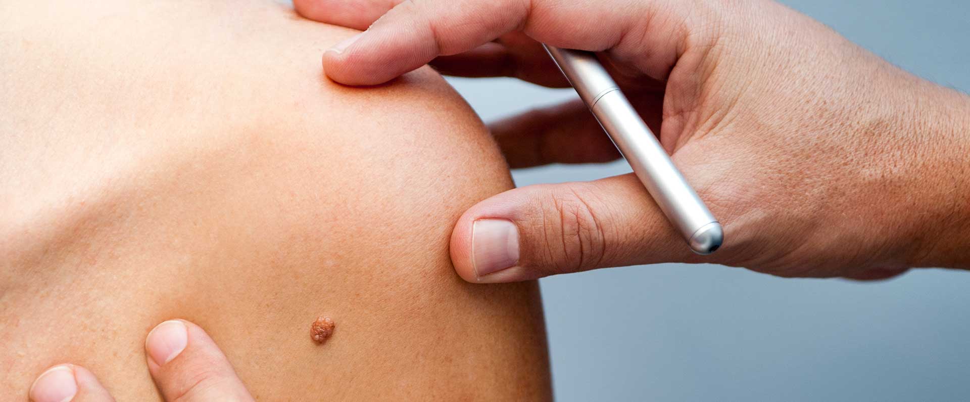 Você tem risco para o câncer de pele?