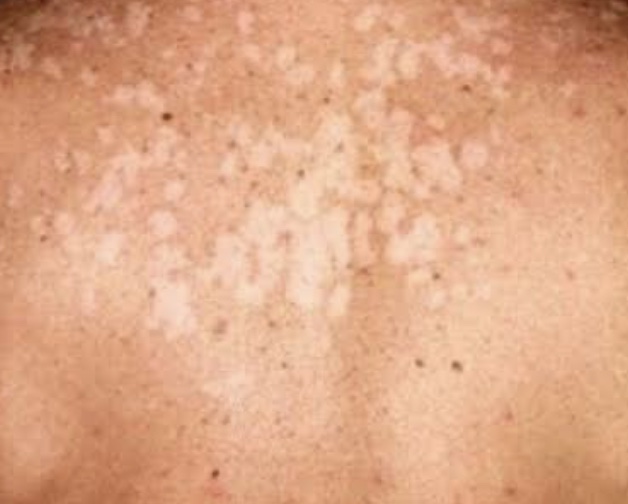Micoses da pele  Especialidade - Tratamento - Dr Mariante